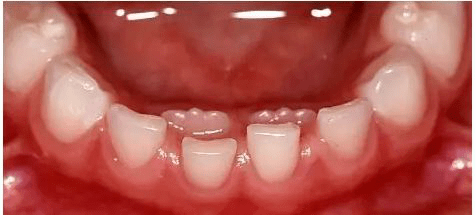 双重影像牙齿串·揭秘隐藏在笑容背后的秘密