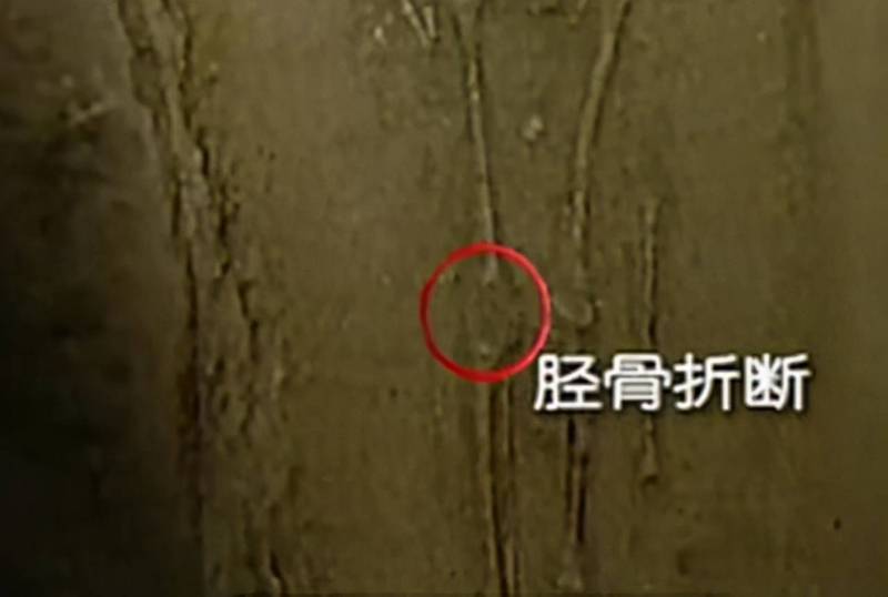 消失的刻度骨针丨一场离奇的谜题 消失的刻度骨针丨一场离奇的谜题