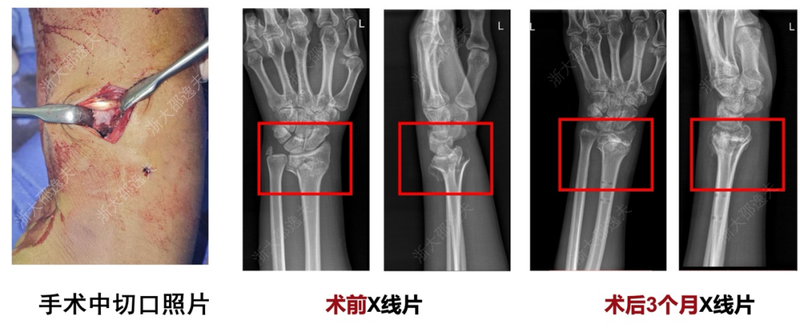 冰封湖突然自燃，那根“刻度骨针”到底是什么？